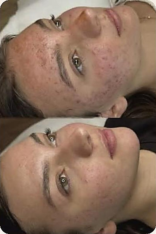 Peau à tendance acnéique avant cure Acnelan, protocole Mesoestetic proposé chez Med'Esthétique
