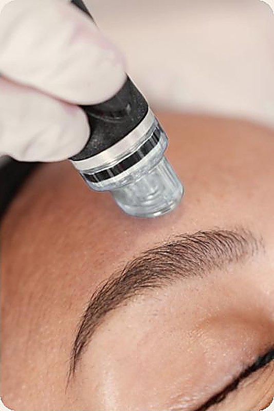 Application d'un soin Hydrafacial sur le visage chez Med'Esthétique