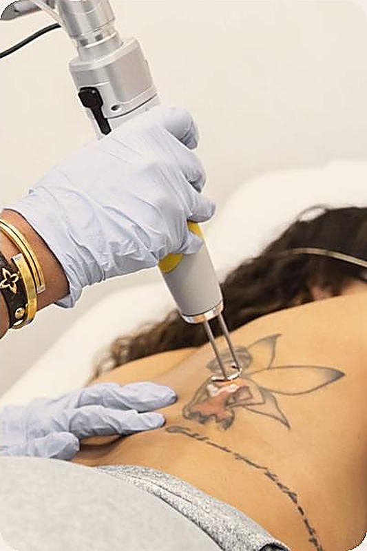 Séance de détatouage laser en cours chez Med'Esthétique